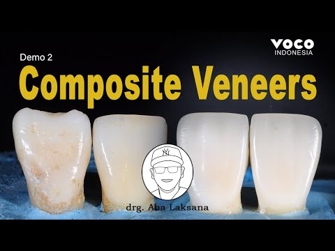 Anterior Composite Veneers Restoration with Layering Technique