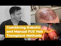 Dr. Max goes over a recent procedure in which both Robotic and Manual FUE hair transplant methods were used.