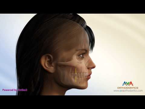 Surgical Orthodontic Treatment for Overjet (Overbite) - Maxillary Setback