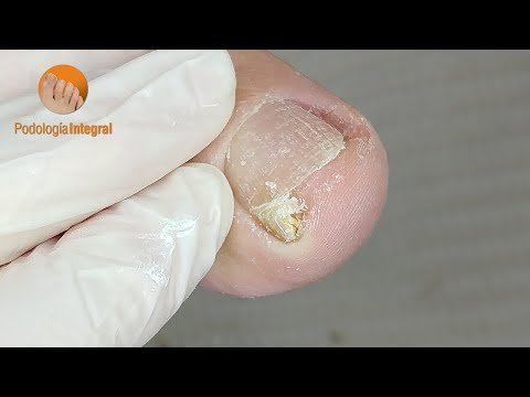 Bye bye nail discomfort! Welcome total cleaning! [Podología Integral]