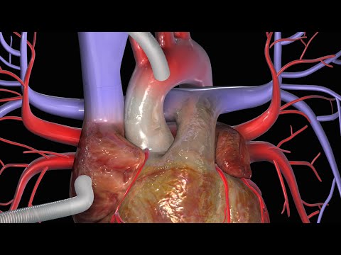 Heart Bypass Surgery (CABG)