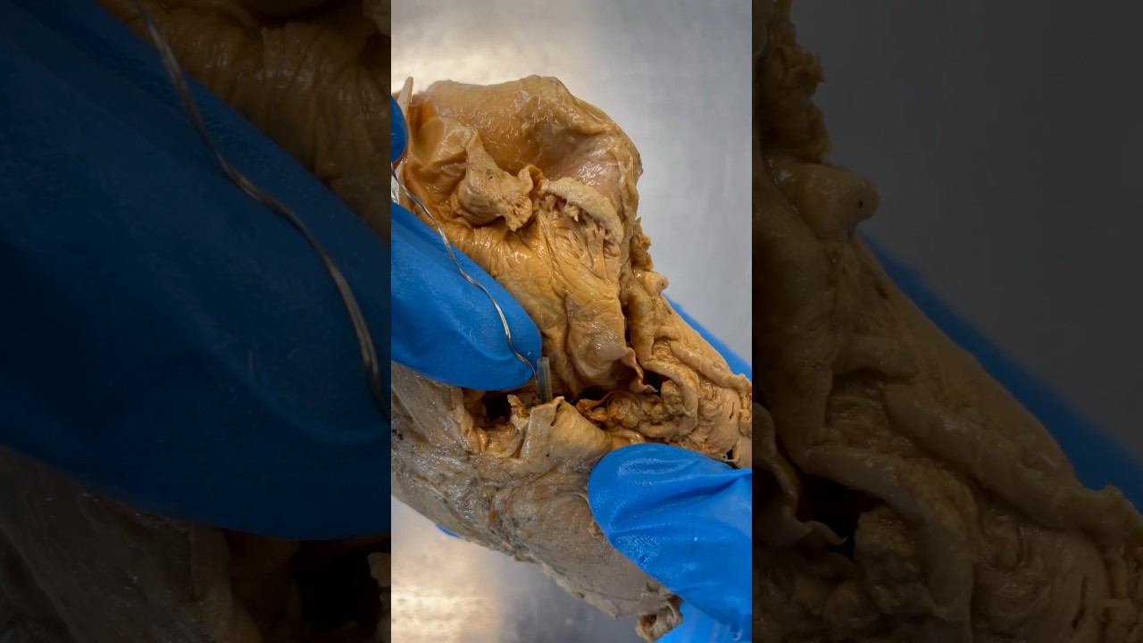 Pacemaker In Real Human Heart