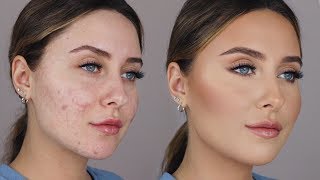 HOW TO COVER ACNE SCARS *easy & non cakey*