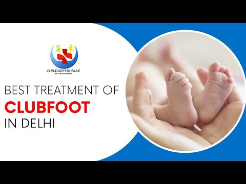 image-Is clubfoot curable permanently?