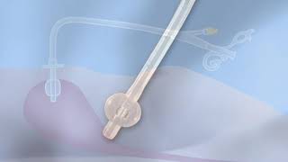 M270BR - Common Feeding Tubes: Replacement Balloon Gastrostomy Tubes