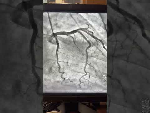 Expert advise: Hints on how to decrease the amount of radiation during Heart Cath.!