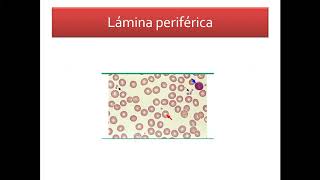 Plaquetopenia - Dra. Laura Llambí