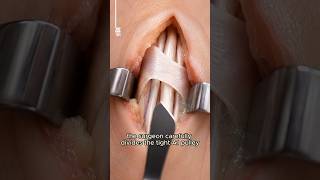 How Doctors Fix Trigger Finger