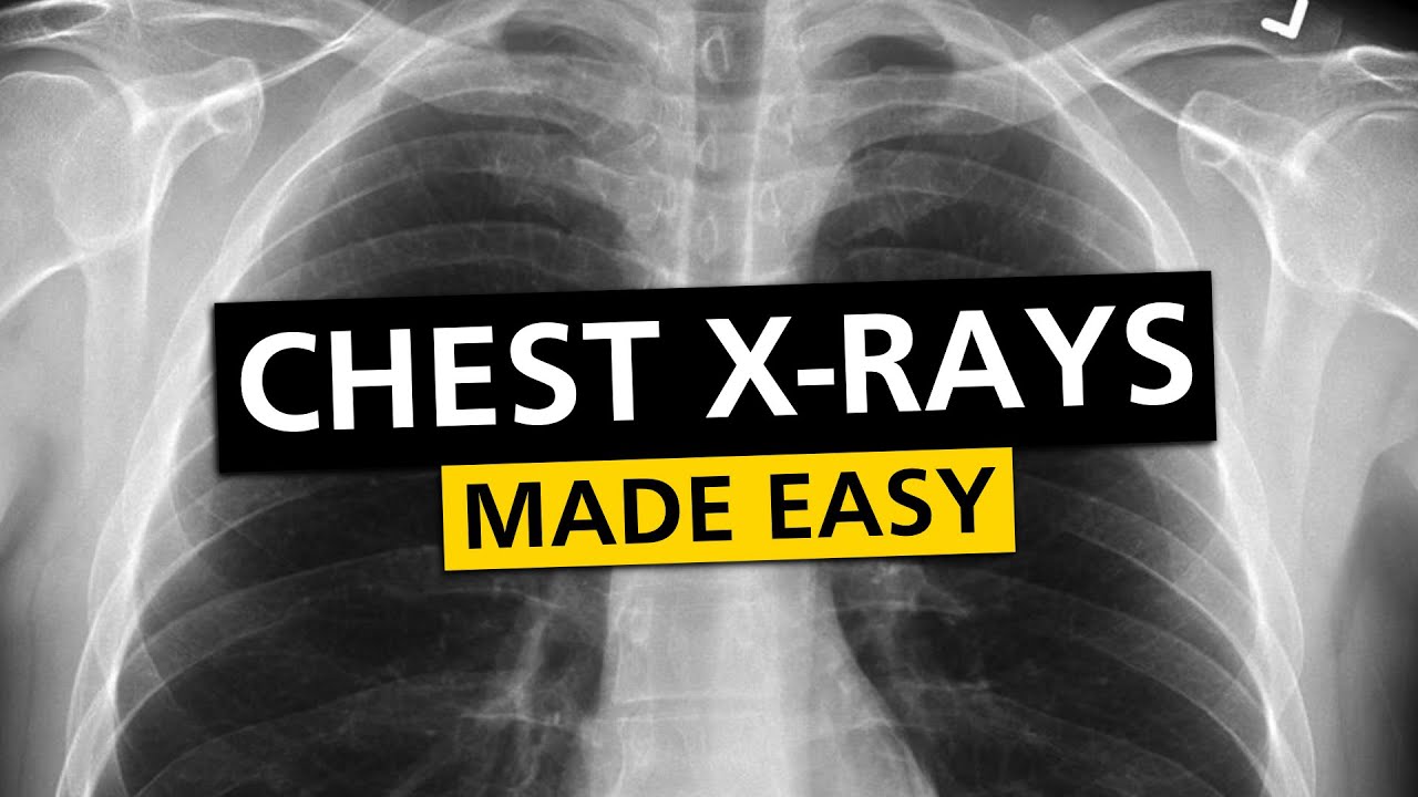 Chest X Rays (CXR) Made Easy! - Learn in 10 Minutes!