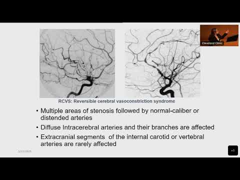 CNS vasculitis