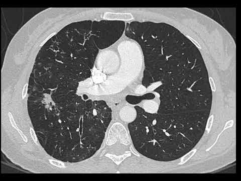 Bronchiectasis with lung nodule