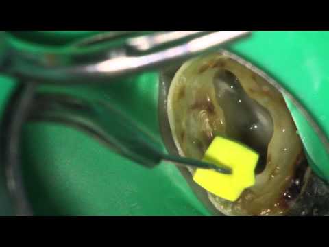 Oval Canals - Endodontic Access Preparation