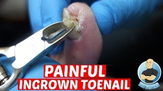 EXTREME PAINFUL INGROWN TOENAIL REMOVAL-DID IT HURT TO REMOVE IT?