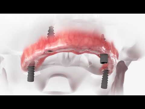 All-on-4 – Fiksni zubi u samo 3 sata! | Orto Nova
