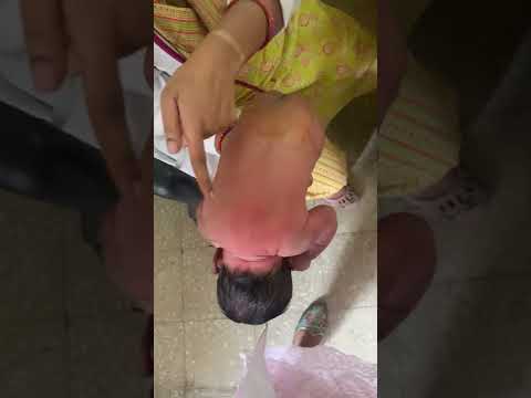 Neonatal Reflex. Galant Reflex. Primitive Reflex