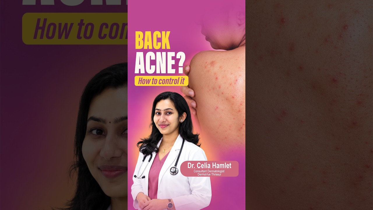 Back Acne Treatment: Causes and What Really Works:Dermatologist Tips #acne #acnetreatment  #skincare