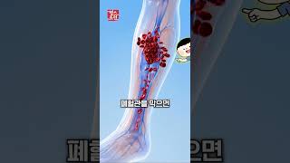AI가 병원 가지 말고 쉬라고 했는데 폐색전증? ???? 죽을 뻔한 실화 오픈AI 소송 #건강 #shorts
