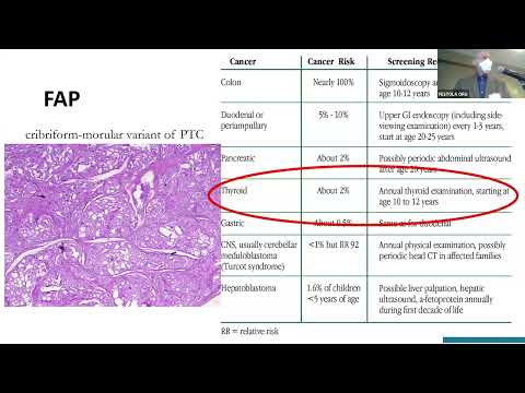 Use of Affirma Genetic Testing for FNAs to predict Thyroid Cancer