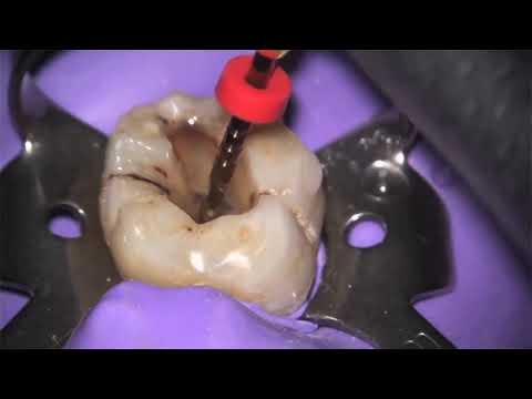 Dentsply Protaper Nickel Titanium Rotary Files | pinkblue