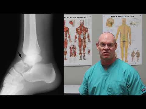 Talus Fracture | Fracture Friday Episode 32