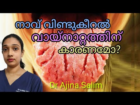 Fissured Tongue in Malayalam | നാവ് വിണ്ടുകീറൽ | Dr Ajina Salim