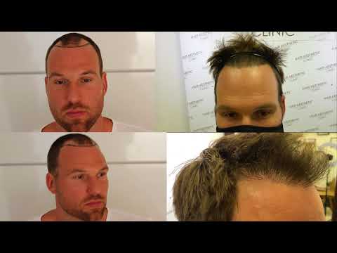 Hair Transplant FUE (1056 Grafts) Result /...