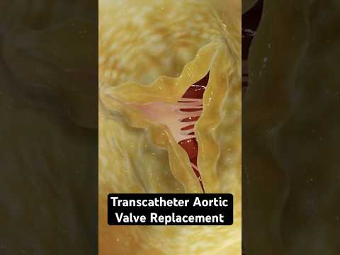 Replacing a valve in your heart (3D animation)