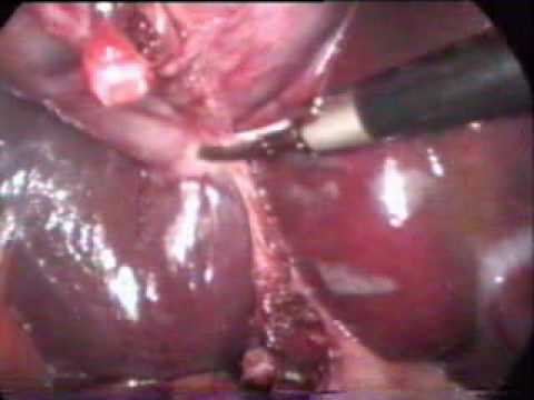 Laparoscopic cholecystectomy