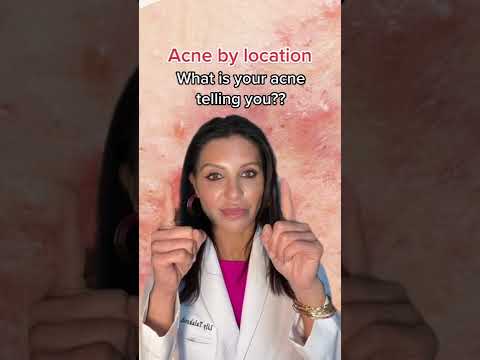What Your Acne Means By Location According to A Dermatologist #shorts