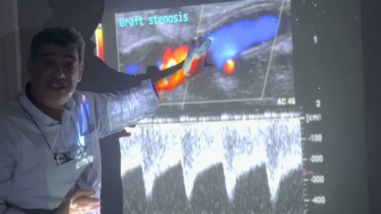 How to predict / detect Stenosis In Graft AVF |English Version