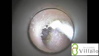 耳掃除動画vol.22「しっとり耳垢の色白さん」