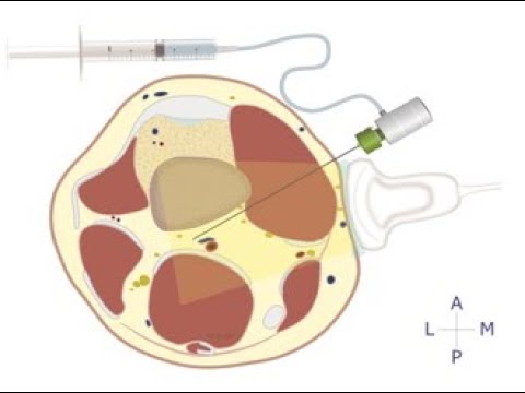 IPACK Discussion 042921