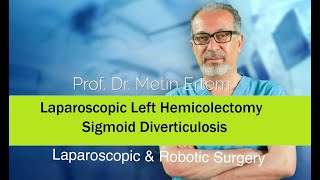 Miniaturka - Laparoscopic left hemicolectomy :Sigmoid Diverticulosis. Metin Ertem MD.FACS.