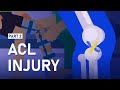 How ACL Injury is Diagnosed and Treated