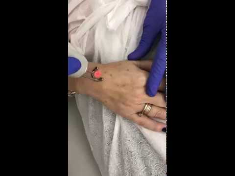 usuwanie przebarwień dłonie discovery pico kaniowscy dermapuls wrocław