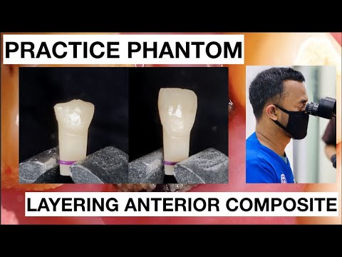 Step by Step Layering Anterior Composite | Finishing Polishing Composite
