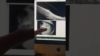 Download Lagu How to avoid corneal transplantation in severe keratoconus: a case example Kanellopoulos, MD Thumbnail