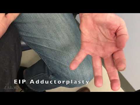 Tendon Transfer Surgery Post Operative Recovery for Claw Hand