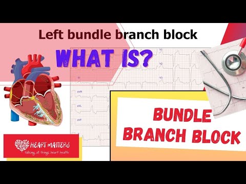 What is a bundle branch block and is it serious?