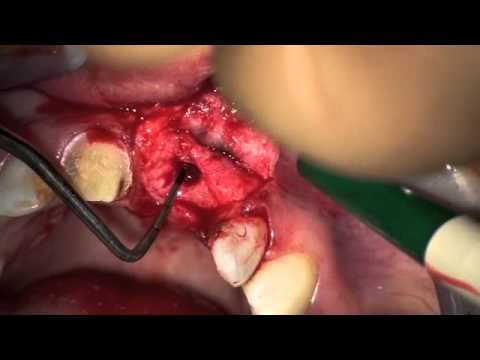 Delayed Implant Placement - Bone Manipulation with Osteostomes