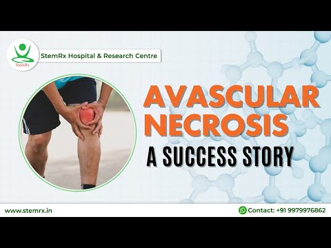 Unlocking the Power of Stem Cells in Avascular Necrosis Treatment