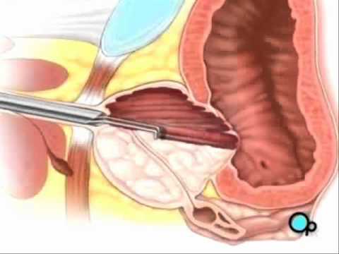 Prostata Inoltre in Ucraina Dispositivo Unione Apollo per prezzo della prostata
