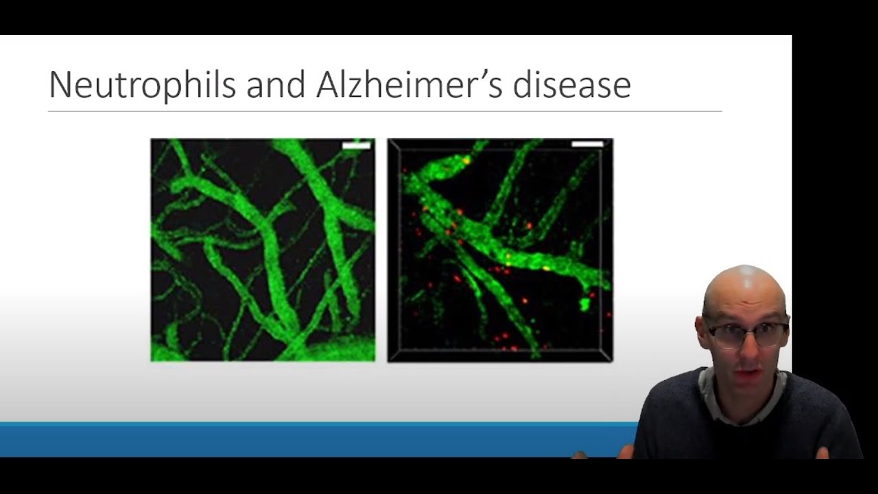 Neuroinflammation in Alzheimer's Disease: The Role of Neutrophils