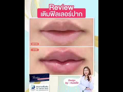 รีวิวหัตถการฟิลเลอร์ปาก