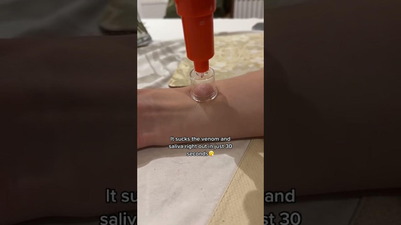 Venom Extractor to the rescue! 🫡 #sting #bug #venomextraction #bugbites #mosquito #insectbite #bite