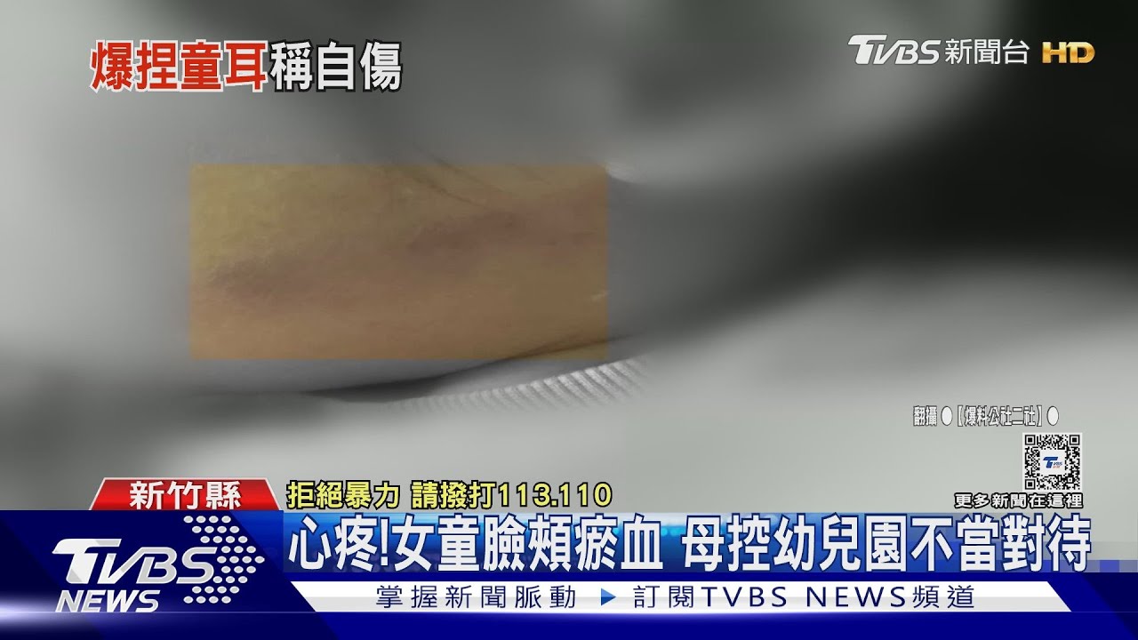 心疼! 女童臉頰瘀血 母控幼兒園不當對待