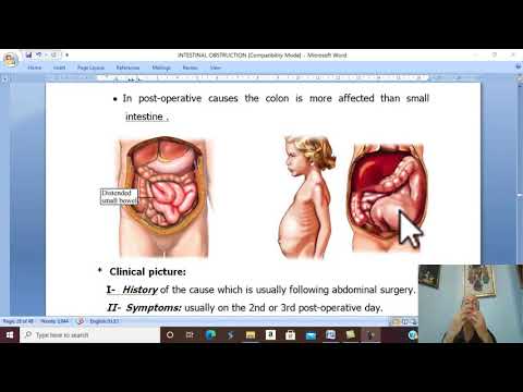 Intestinal disorders in Arabic 6 ( Paralytic ileus ) , by Dr. Wahdan