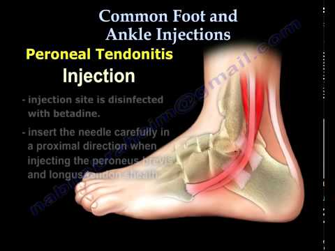 Common Foot And Ankle Injections