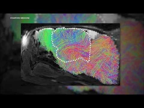 Stanford researchers successfully grow human brain tissue ...