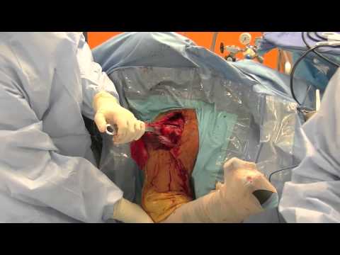 Laserbehandlung von Gelenken Die geeignet ist, Salbe der Osteochondrose